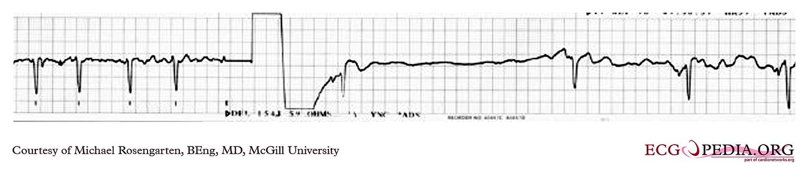 EKG ved atrieflimmer