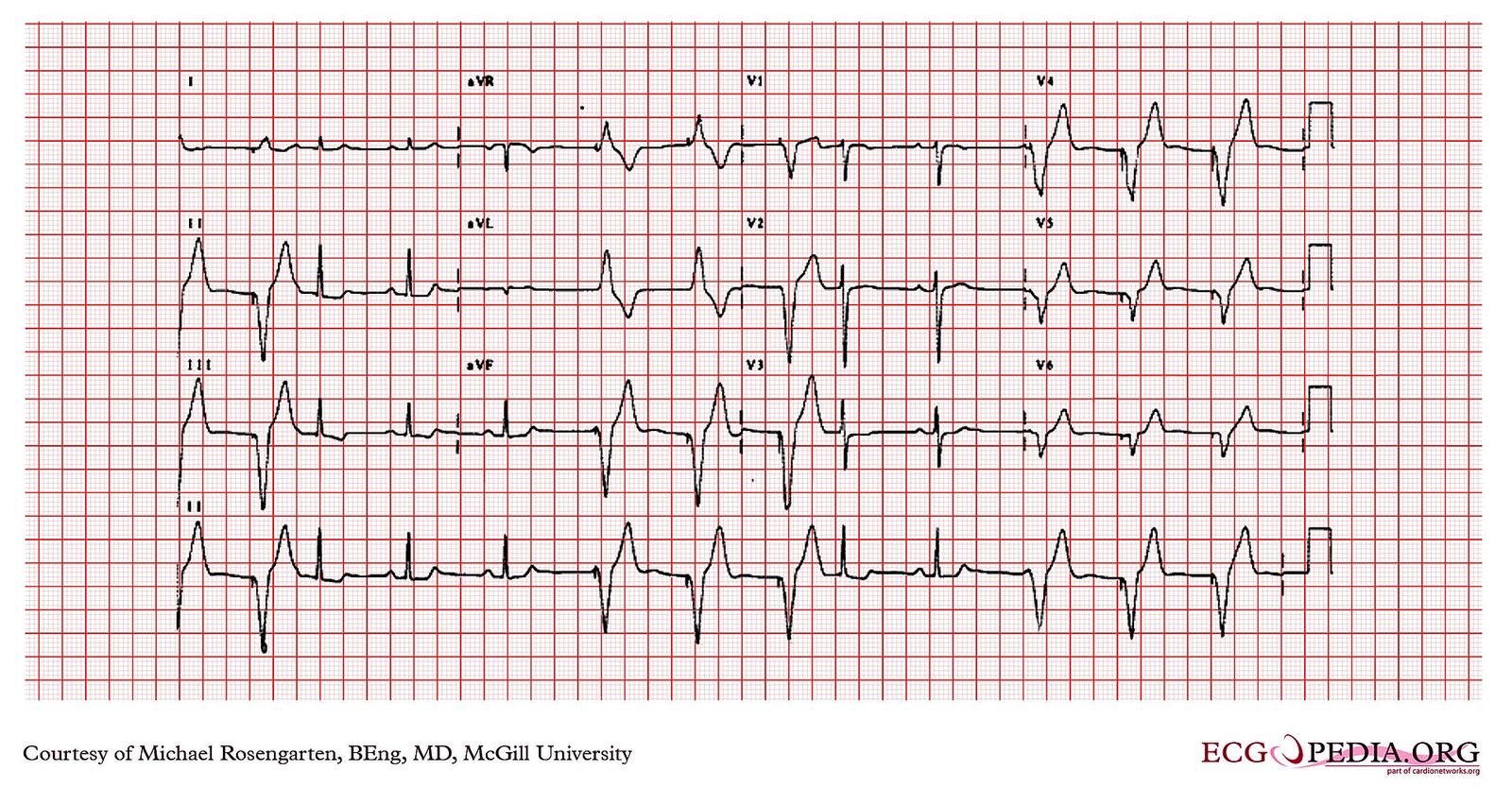 EKG (elektrokardiogram) - normal hjerterytme