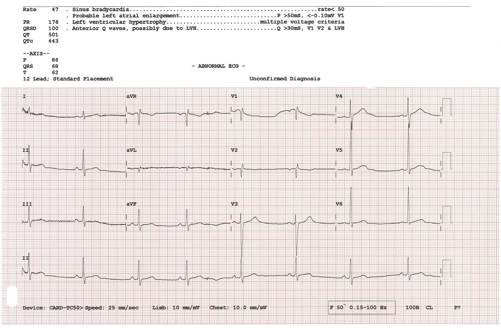 EKG ved STEMI hjerteinfarkt - ST-elevering