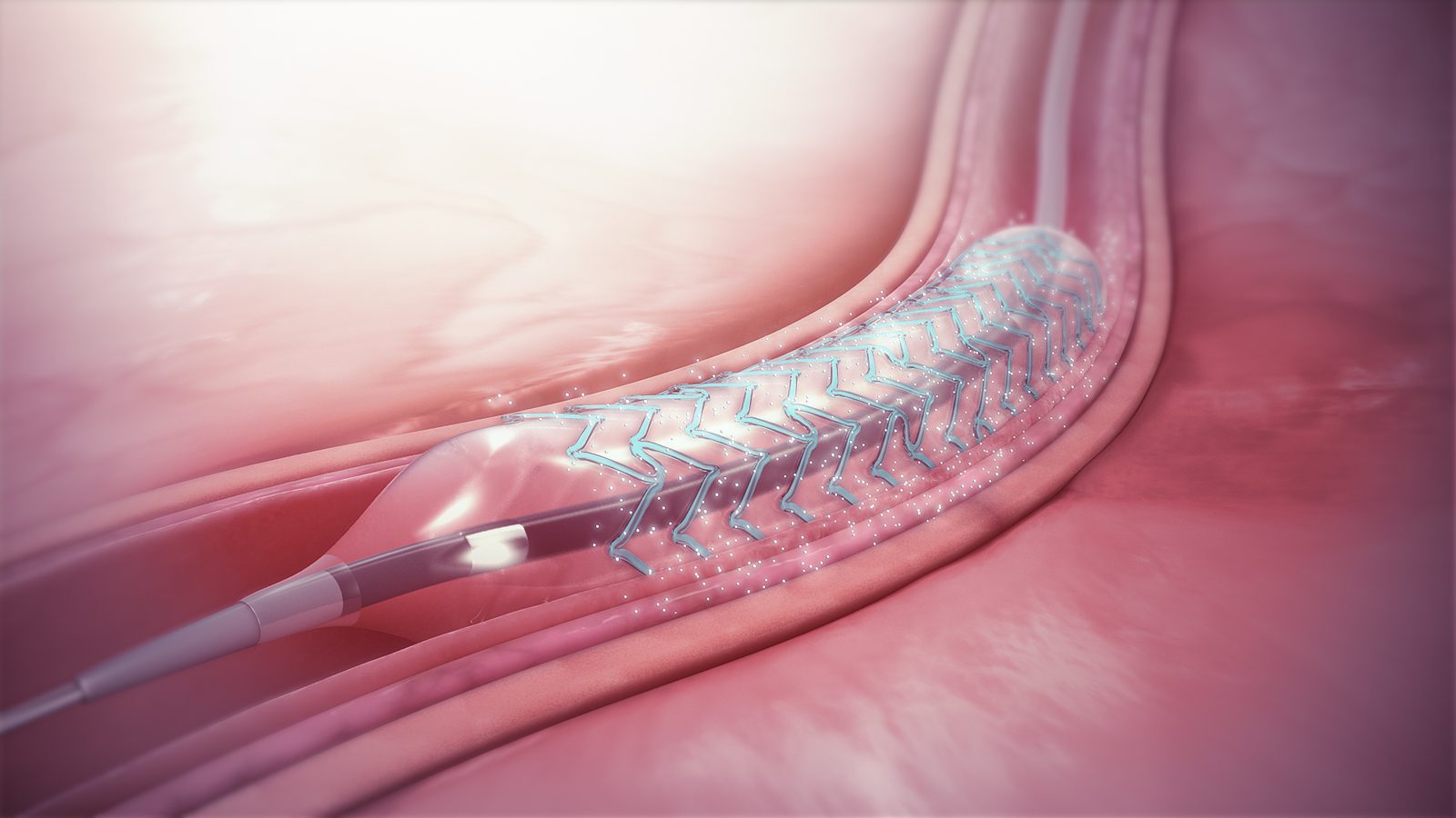 Koronar stent - metallnett for arserieutvidelse